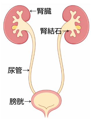 腎・尿管結石