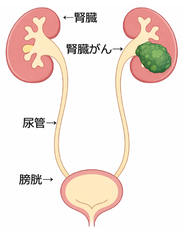 腎臓がん
