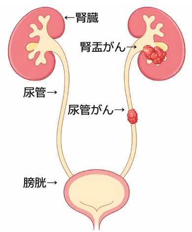 腎盂・尿管がん