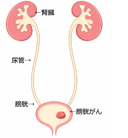 膀胱がん